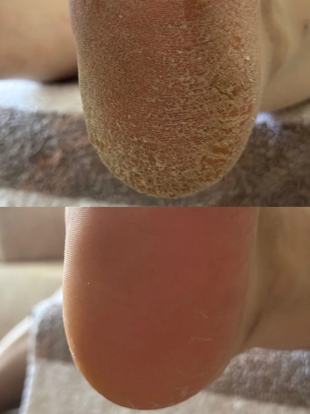 Topuk bakımı öncesi ve sonrası